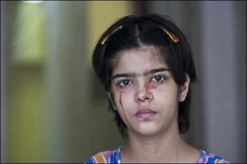 7 Penyakit Paling Aneh di Dunia, Masuk gan !