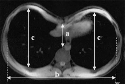 Mengenal Pectus Excavatum (penyakit dada cekung)