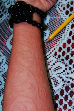 Skin Writing, Penyakit Kulit yang Bikin Iri