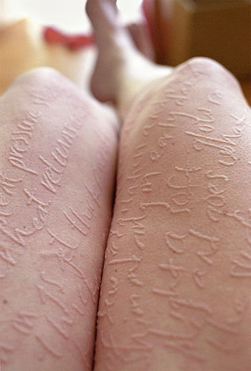 Skin Writing, Penyakit Kulit yang Bikin Iri