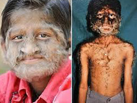 penyakit langka yang ada didunia..... tarraaaaa.......