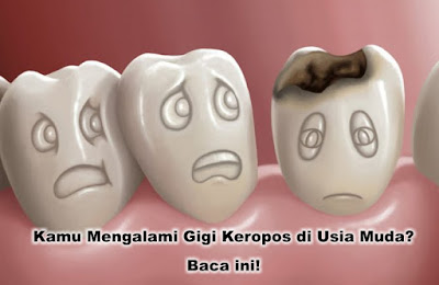 Kamu Mengalami Gigi Keropos di Usia Muda? Baca ini!
