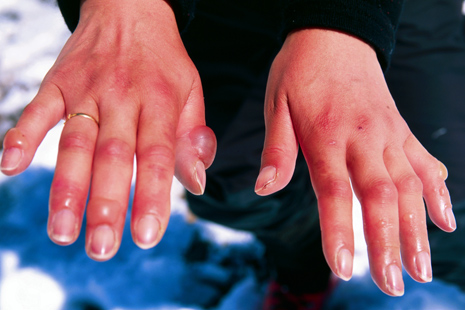 Mengenal Radang Dingin