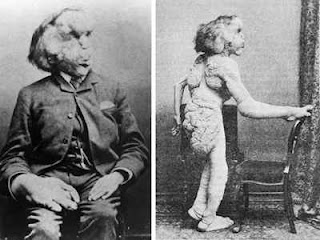 &#91;KASIHAN GAN&#93; 10 Orang dengan Kelainan Aneh Paling Fenomenal dalam Sejarah