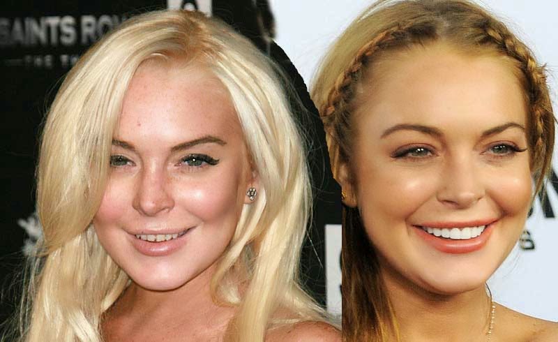 Lihat Tampang Artis Holywood ini Sebelum dan Sesudah Giginya di Vermak