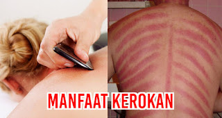 Fakta Sebenarnya Manfaat Kerokan Untuk Kesehatan