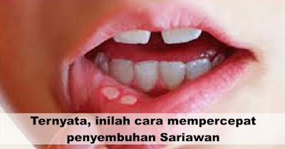 ternyata-inilah-cara-mempercepat-penyembuhan-sariawan