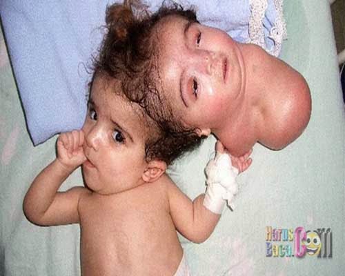 Kelainan Tubuh Manusia Paling Ekstrem 