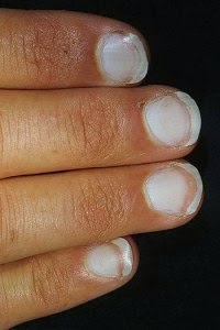 Ternyata, Bentuk Dan Warna Kuku MENUNJUKKAN KESEHATANMU