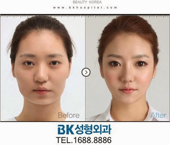 61 Contoh Foto Operasi Plastik Orang Korea 