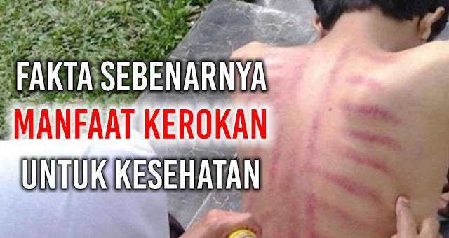 fakta-sebenarnya-manfaat-kerokan-untuk-kesehatan