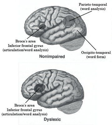 Mari Mengenal Dyslexia/Disleksia