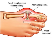 Waspadalah!! Ini Penyebab asam urat di usia muda