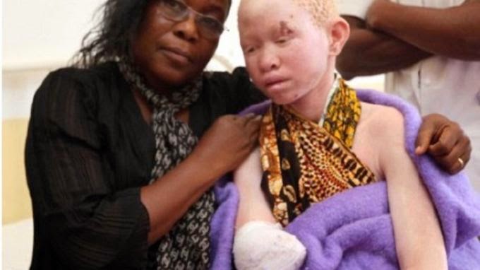 di-tanzania-orang-albino-diburu-dan-dibunuh-seperti-binatang