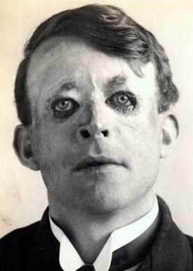 Orang Pertama yang Melakukan Operasi Plastik Di Dunia