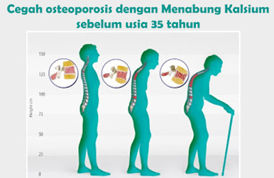 yuk-cegah-osteoporosis-dengan-menabung-kalsium-sebelum-usia-35-tahun