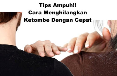 Tips Ampuh!! Cara Menghilangkan Ketombe Dengan Cepat 