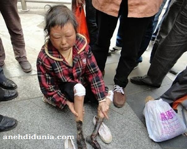 &#91;UNIK&#93; Seorang Wanita Di China Memiliki Kaki Seperti Mumi