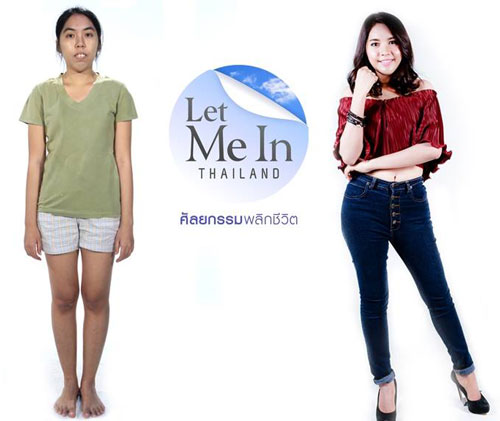 Gadis Thailand Bergigi Tonggos Jadi Cantik Dahsyat Setelah Operasi Plastik Gratis