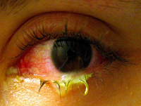 Sakit Mata Menular Melalui Tatapan Mata? Benarkah Demikian ?