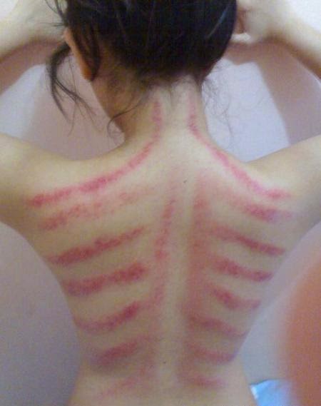 penyebab-memar-tiba-tiba-bukan-karena-dijilat-setan