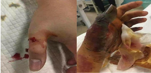 mengerikan-sekali-jari-orang-ini-membusuk-setelah-digigit-hewan-ini