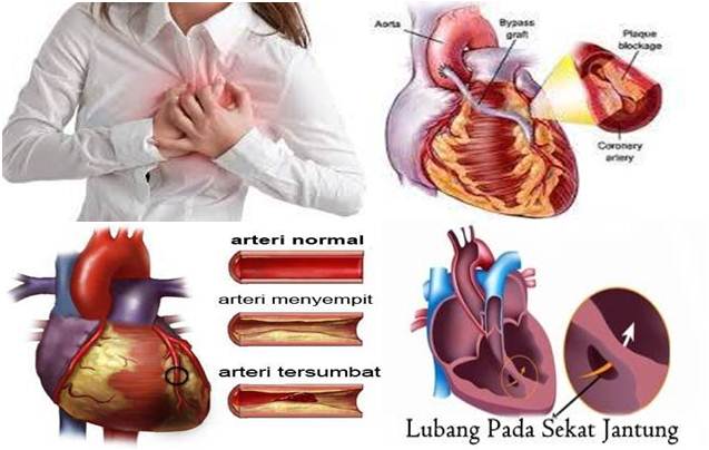 Penyakit Jantung Bocor, Bagaimana Solusi Mengobati dan Biayanya ?