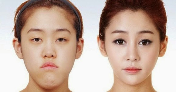 61 Contoh Foto Operasi Plastik Orang Korea 