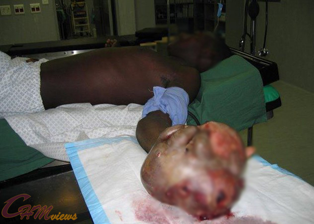 Mengerikan Penyakit Aneh Kembali Terjadi Di Afrika