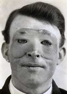 Orang Pertama yang Melakukan Operasi Plastik Di Dunia