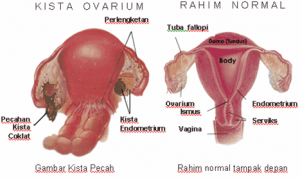 Apa Penyebab Sakit Perut di Sebelah Kiri?