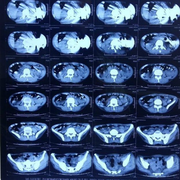 Pria India ini Telan 40 Pisau Selama 3 Bulan, Dokter Berhasil Mengambilnya