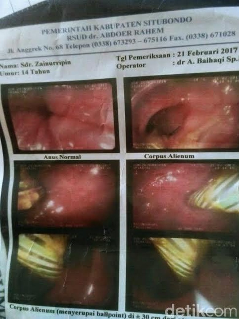 susah-bab-zainurrifin-coba-masukkan-pulpen-lewat-anus
