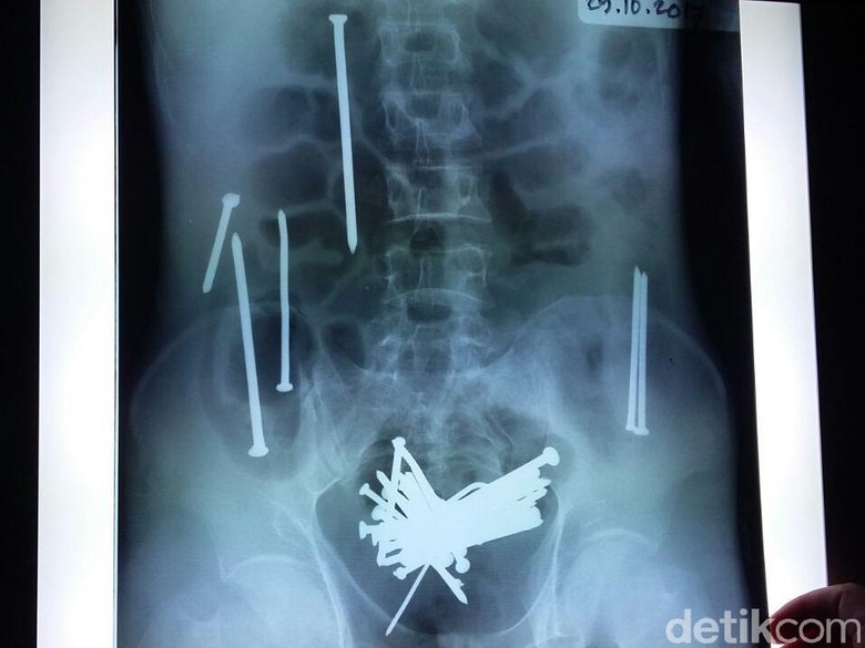 Ini Dia Wawan Lelaki Penuh Paku Pada Perutnya