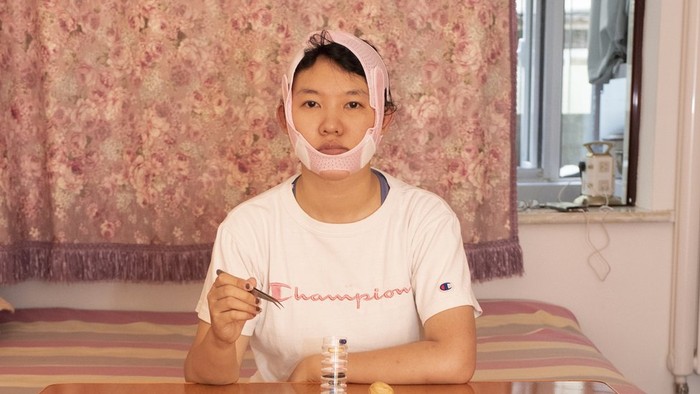 Operasi Plastik Marak di Kalangan Anak Muda di China Meski Bahaya Mengintai