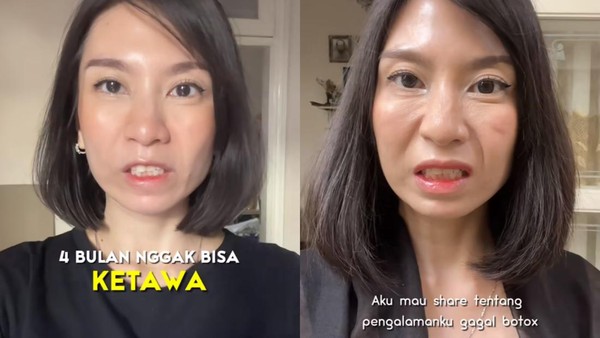 Viral Wanita Solo 4 Bulan Nggak Bisa Ketawa usai Botox Full Face