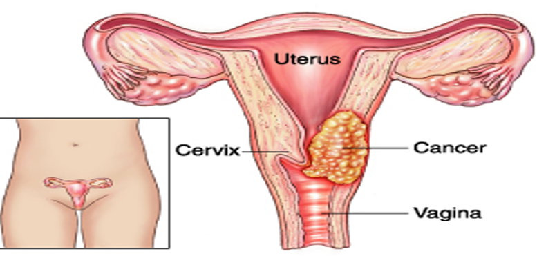 7-mitos-kanker-serviks