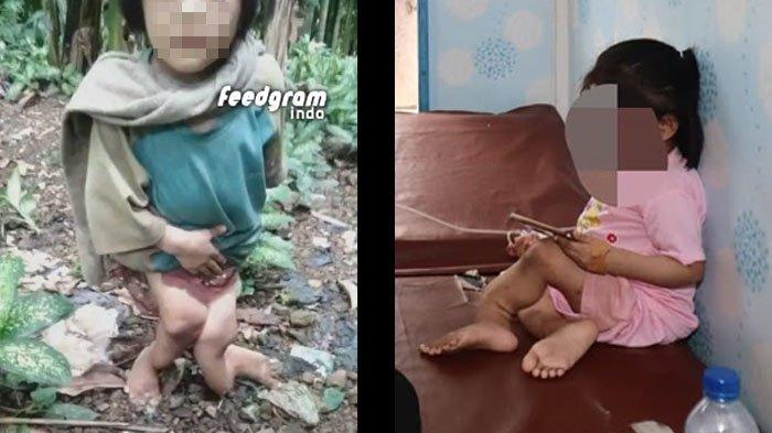 Bocah Perempuan di Nias Disiksa Keluarga , Polisi Syok Lihat Kondisi Kaki Korban