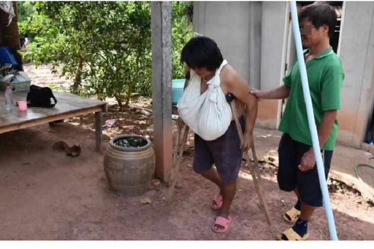 Ngeri! Payudara Wanita Ini Terus Tumbuh Tidak Terkendali