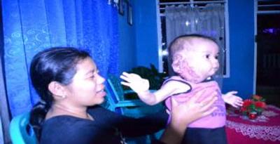 Derita Nurul, Bayi Penderita Kanker Darah