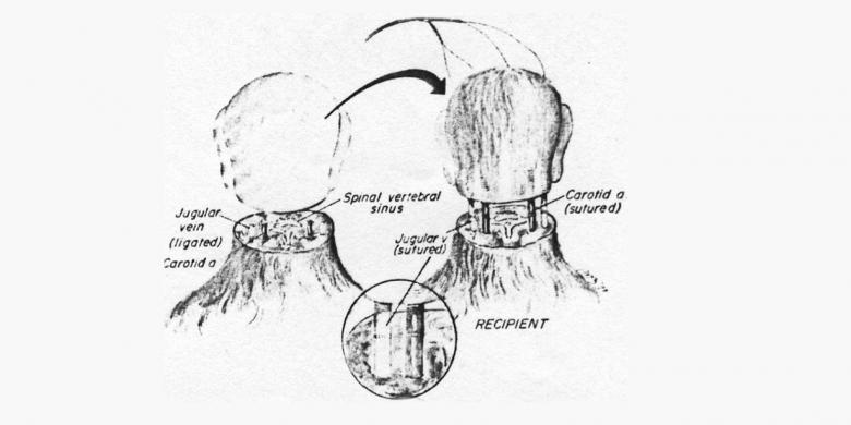 Bukan Cuma Impian, Manusia Sebentar Lagi Bisa Cangkok Kepala