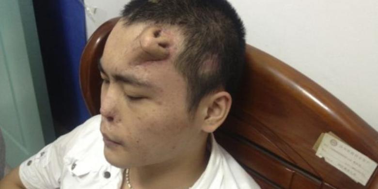 Dokter China &quot;Tumbuhkan&quot; Hidung Baru di Dahi Korban Kecelakaan