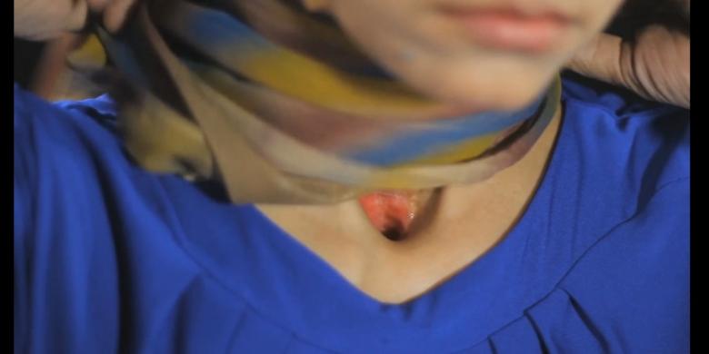 Wanita Ini Kehilangan Suara karena Jadi Perokok Pasif