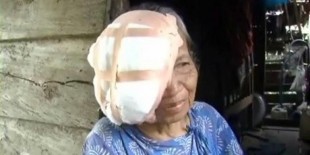 Tak Punya Biaya Berobat, Nenek Ini Pasrah Kepalanya Digerogoti Belatung