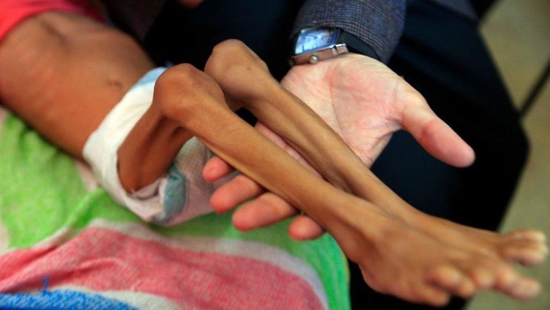 PBB Catat 7 Juta Anak-anak Yaman Alami Kelaparan