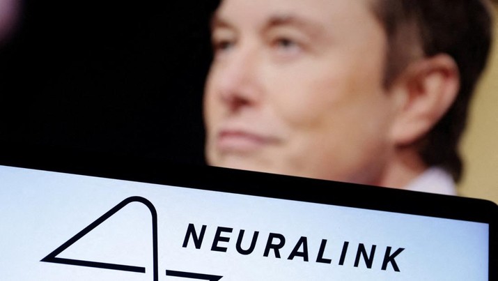 Nasib Ngeri Manusia Pertama yang Ditanam Chip Otak Elon Musk