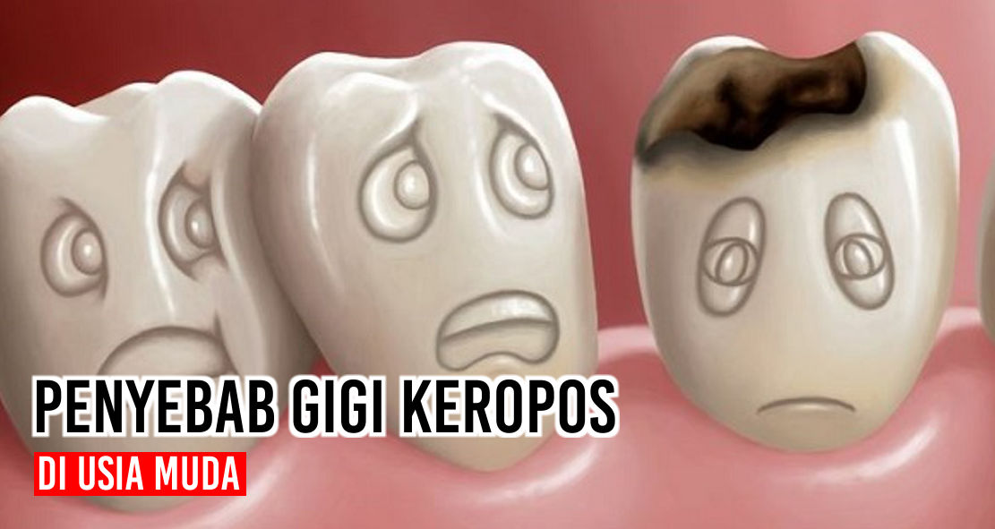 masih-mudah-gigi-udah-keropos--ternyata-ini-penyebabnya