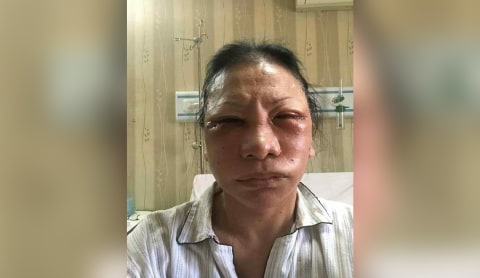 Kronologi Ratna Sarumpaet Saat Operasi Plastikdi RS Bina Estetika