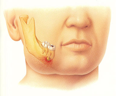 Sakit Gigi? Masuk Gan. Tips Redakan Sakit Gigi Tanpa Obat