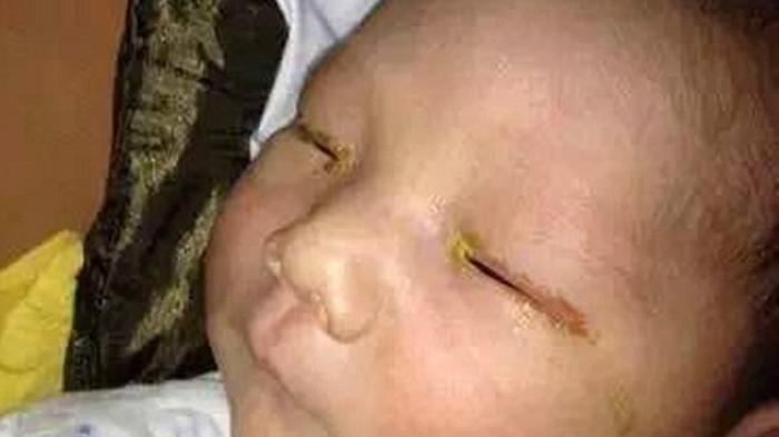Seorang Bayi Buta Setelah Dipotret dengan Gunakan Lampu Flash